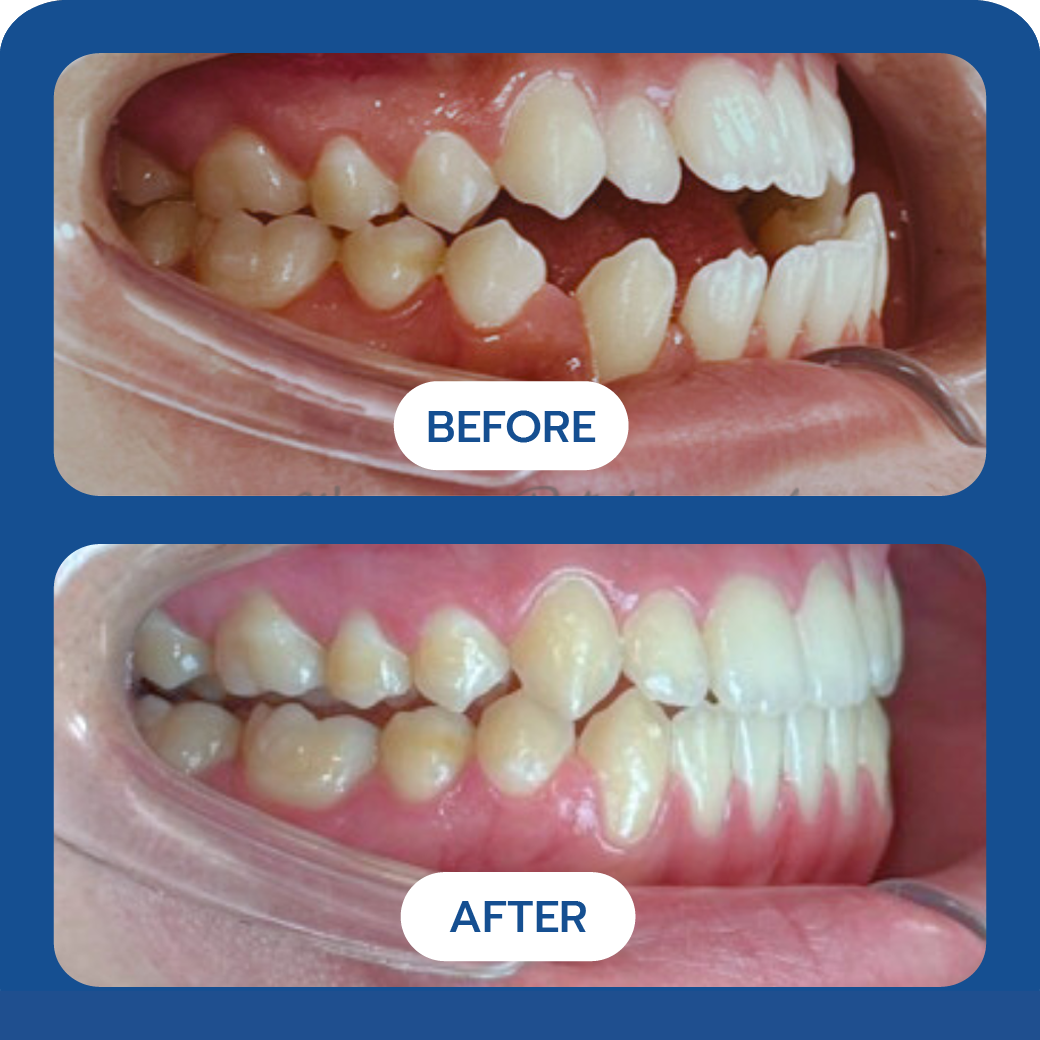 Invisalign Before and After Case 6